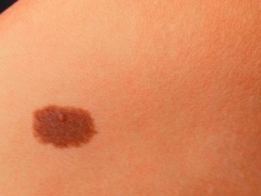 Close-up of a skin birthmark