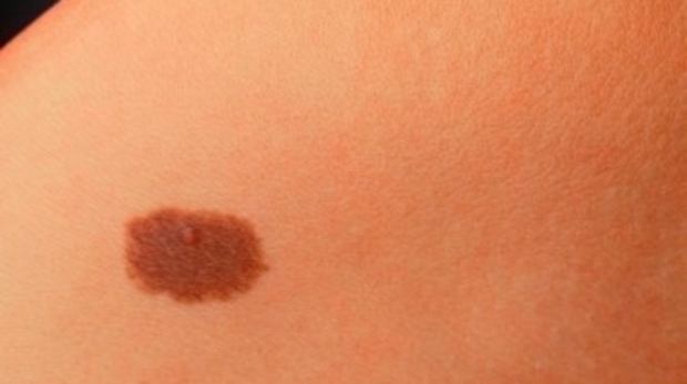 Close-up of a skin birthmark