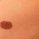 Close-up of a skin birthmark