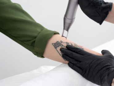 A patient in Riyadh is getting Tattoo Removal Treatment at Saudi Dermatology