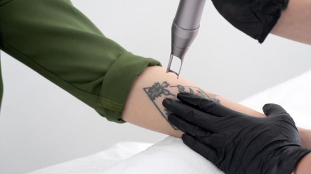 A patient in Riyadh is getting Tattoo Removal Treatment at Saudi Dermatology