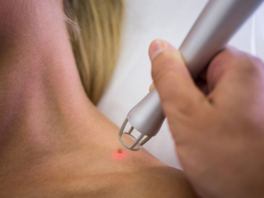 Dermatologist using laser technology to safely remove a mole from a woman’s shoulder.