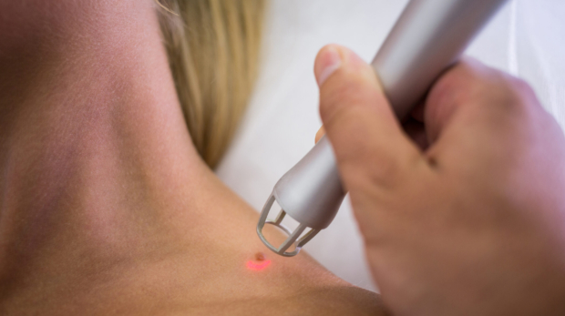Dermatologist using laser technology to safely remove a mole from a woman’s shoulder.