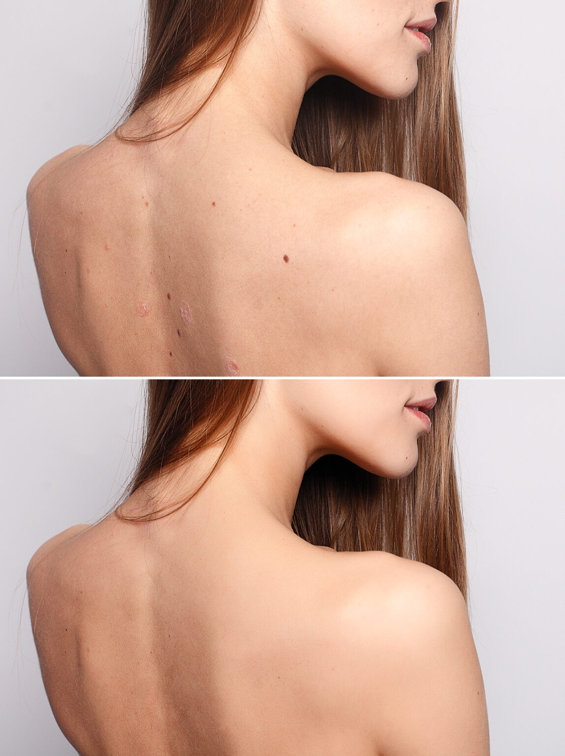 Before and after mole removal treatment showing smooth, clear skin on a woman’s back.