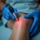 Dermatologist performing laser vein removal on a patient’s leg for spider veins treatment