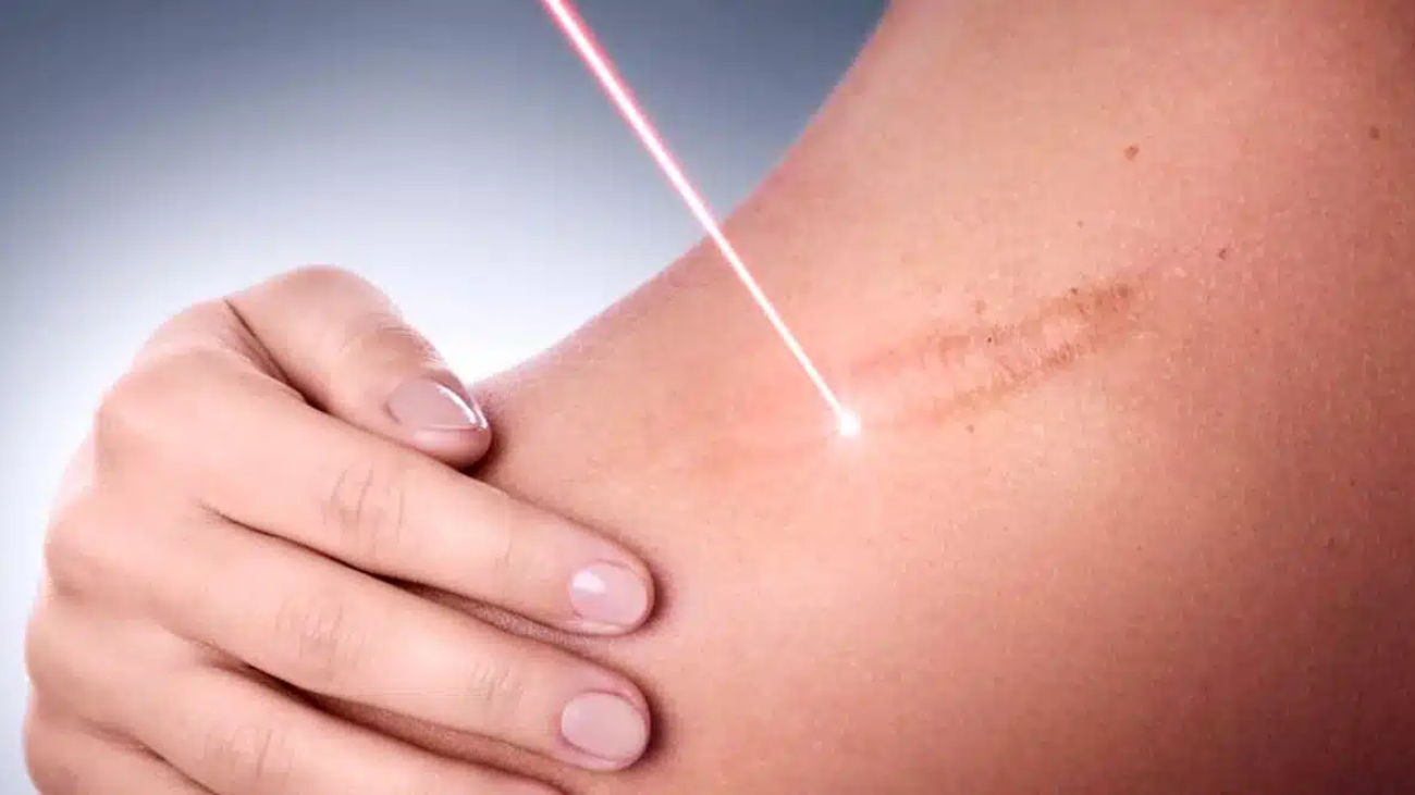 Laser surgical scar removal treatment in Riyadh