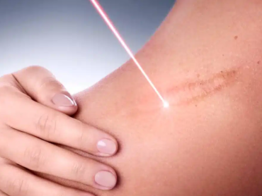 Laser surgical scar removal treatment in Riyadh