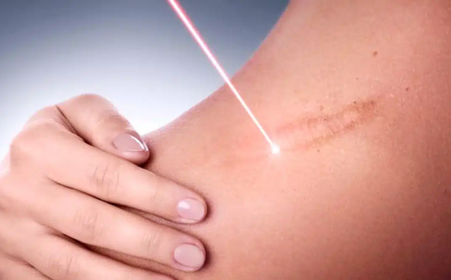 Laser surgical scar removal treatment in Riyadh