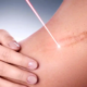 Laser surgical scar removal treatment in Riyadh