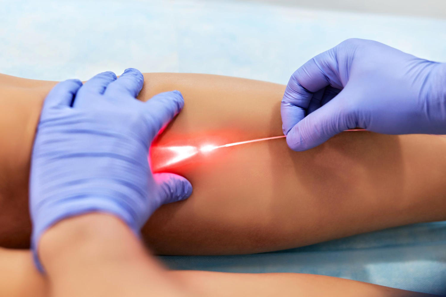 Doctor performing laser vein removal procedure on a patient’s leg