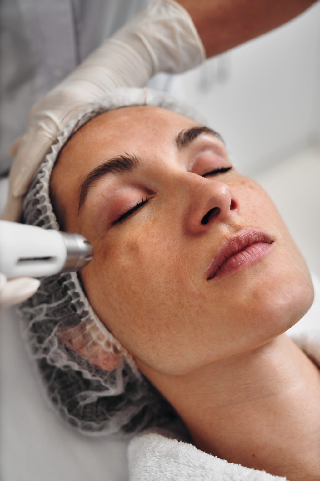 Woman undergoing laser treatment for birthmark removal on face