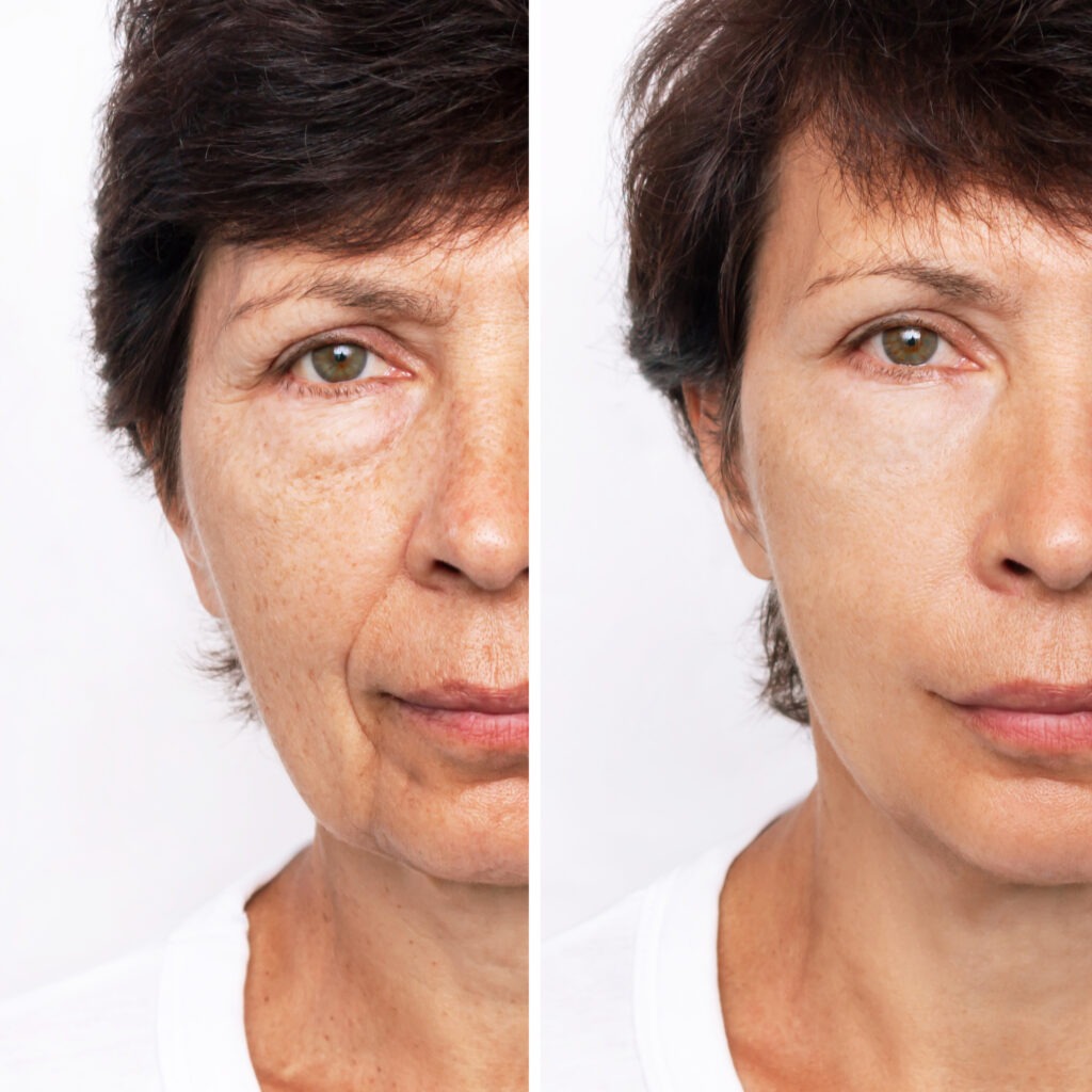 Before and after photos showing skin tightening after Ultherapy treatment