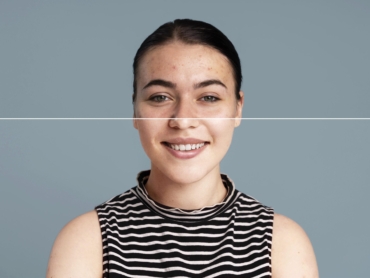 Before and after acne scar treatment using collagen-stimulating microneedling in Riyadh