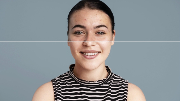 Before and after acne scar treatment using collagen-stimulating microneedling in Riyadh