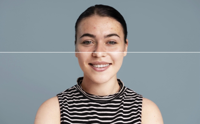 Before and after acne scar treatment using collagen-stimulating microneedling in Riyadh