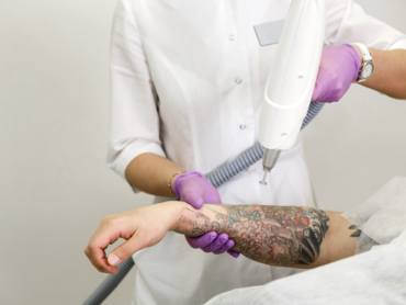Dermatologist performing scar-free tattoo removal with a Picosecond laser.