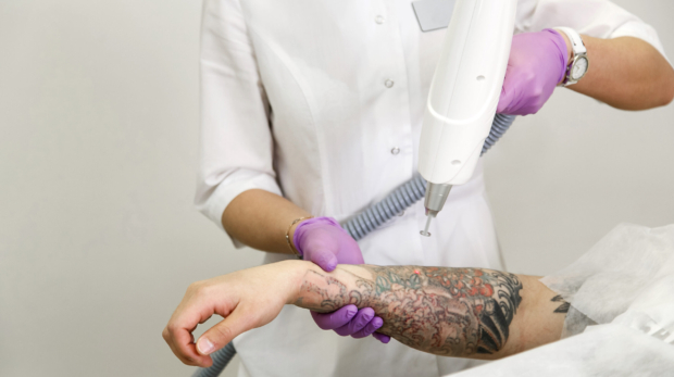 Dermatologist performing scar-free tattoo removal with a Picosecond laser.