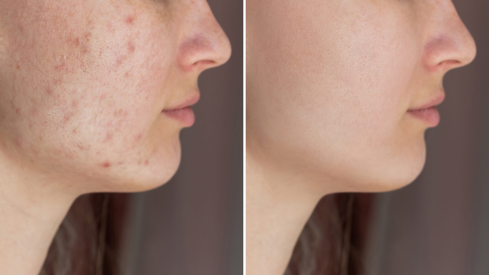 Before and after results of pigmentation treatment on cheeks