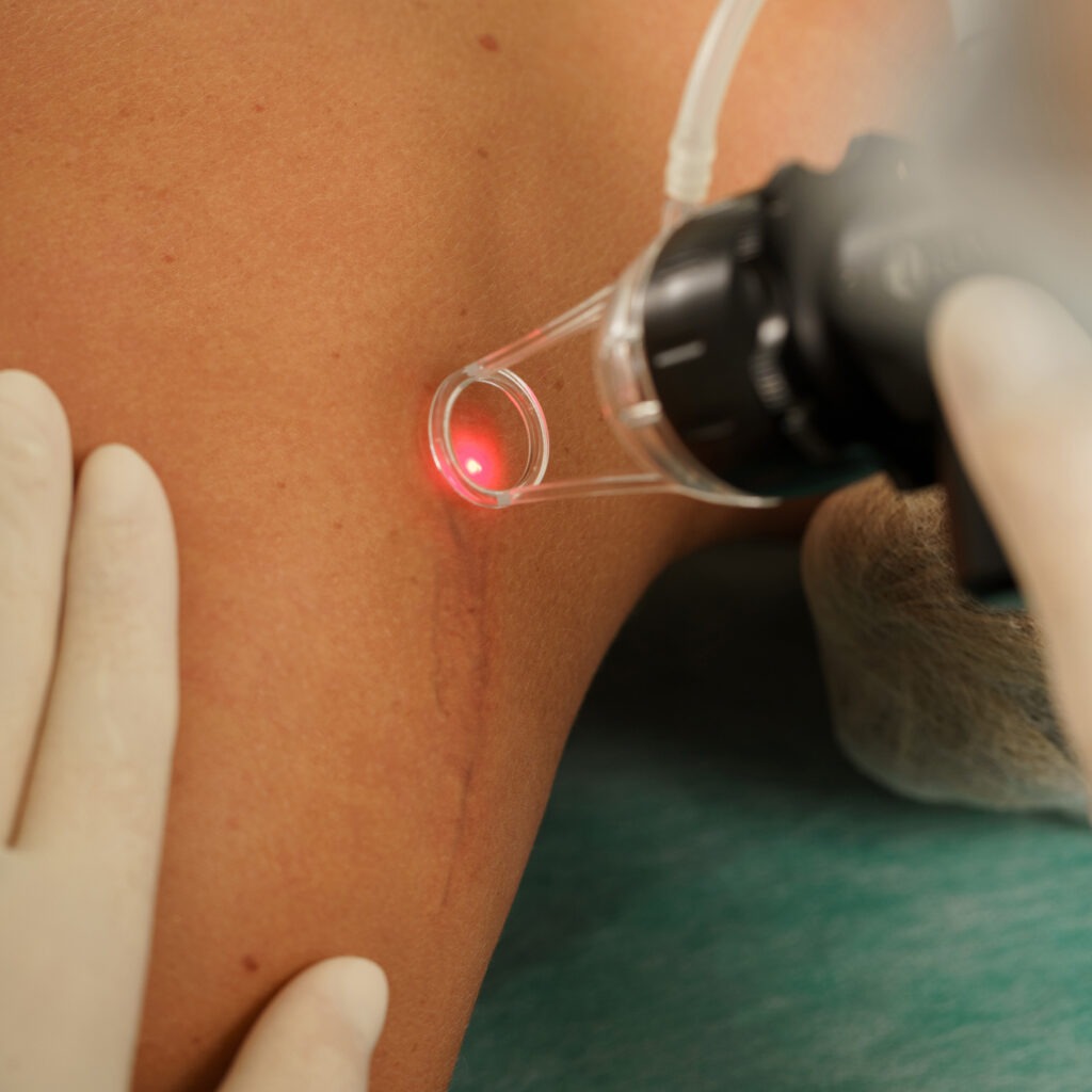 Fractional CO2 laser being used for scar removal on a patient's face