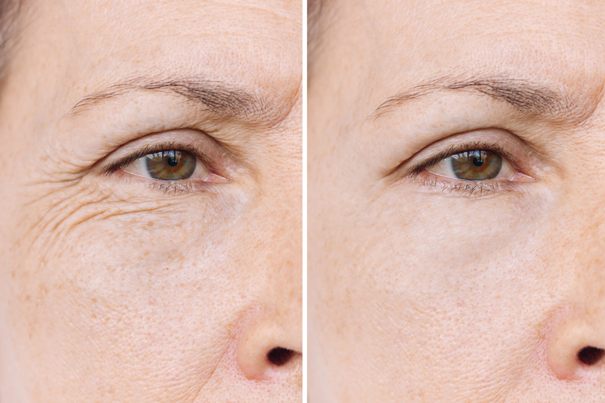 Visible skin texture improvement after fractional laser resurfacing