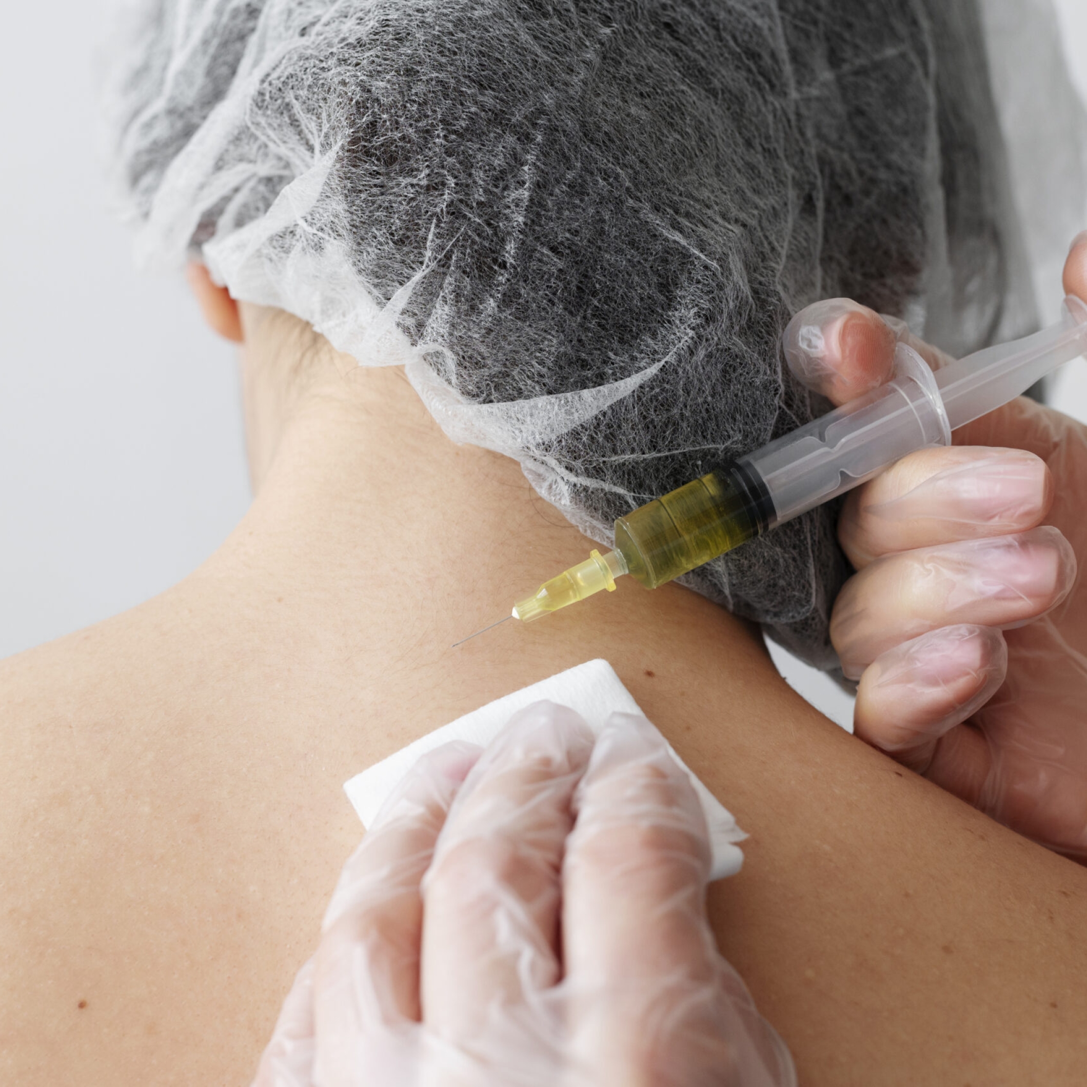 "Platelet-Rich Plasma (PRP) therapy being applied to reduce surgical scars