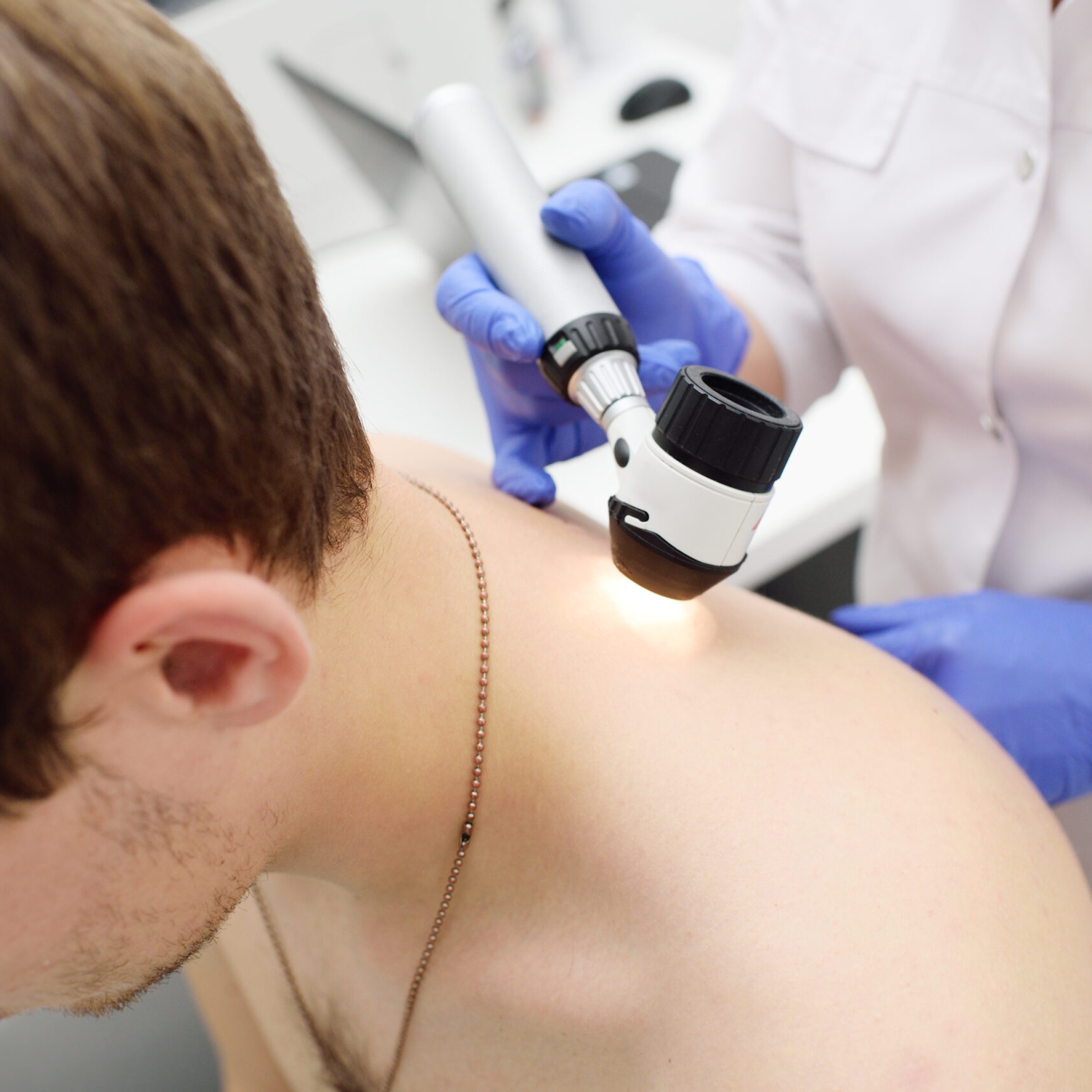 Dermatologist performing dermatoscopic mole examination on a patient’s back