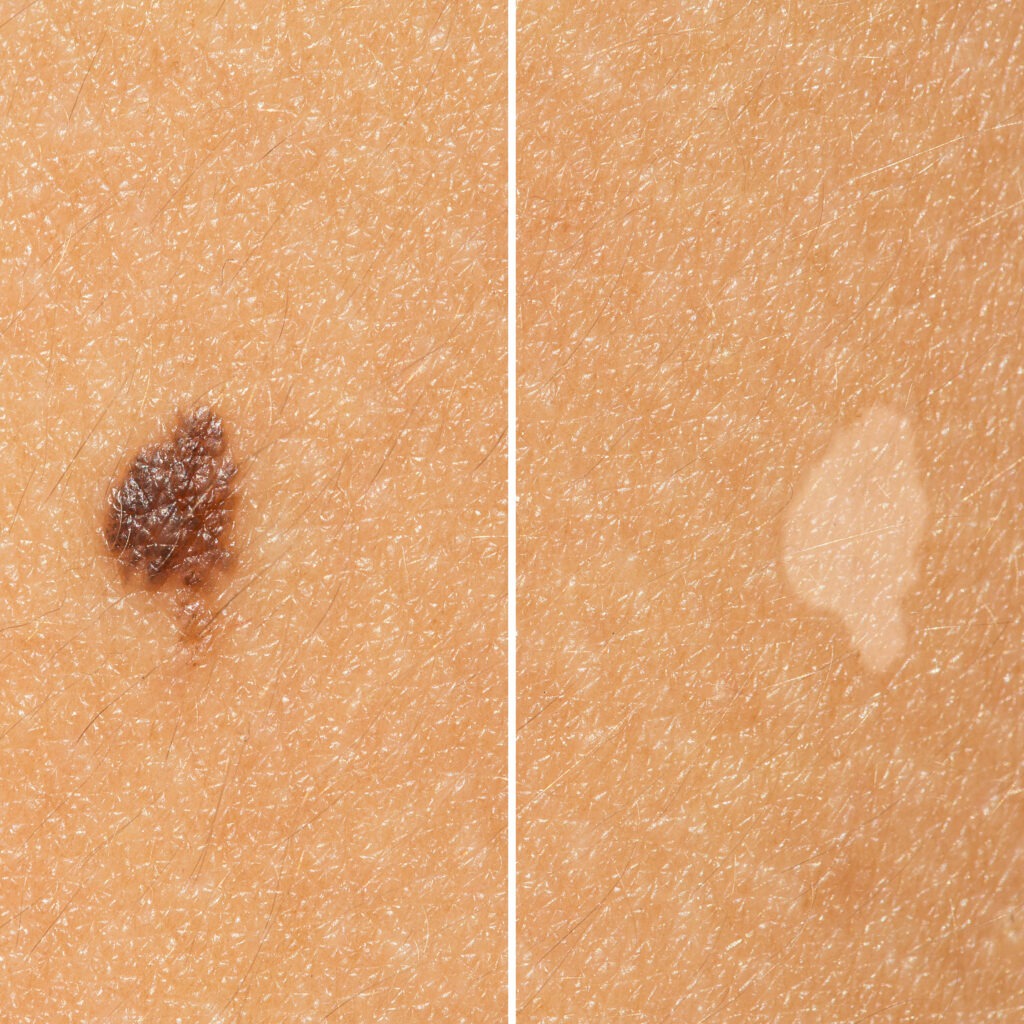 Laser mole removal before and after results in Riyadh – non-invasive skin treatment