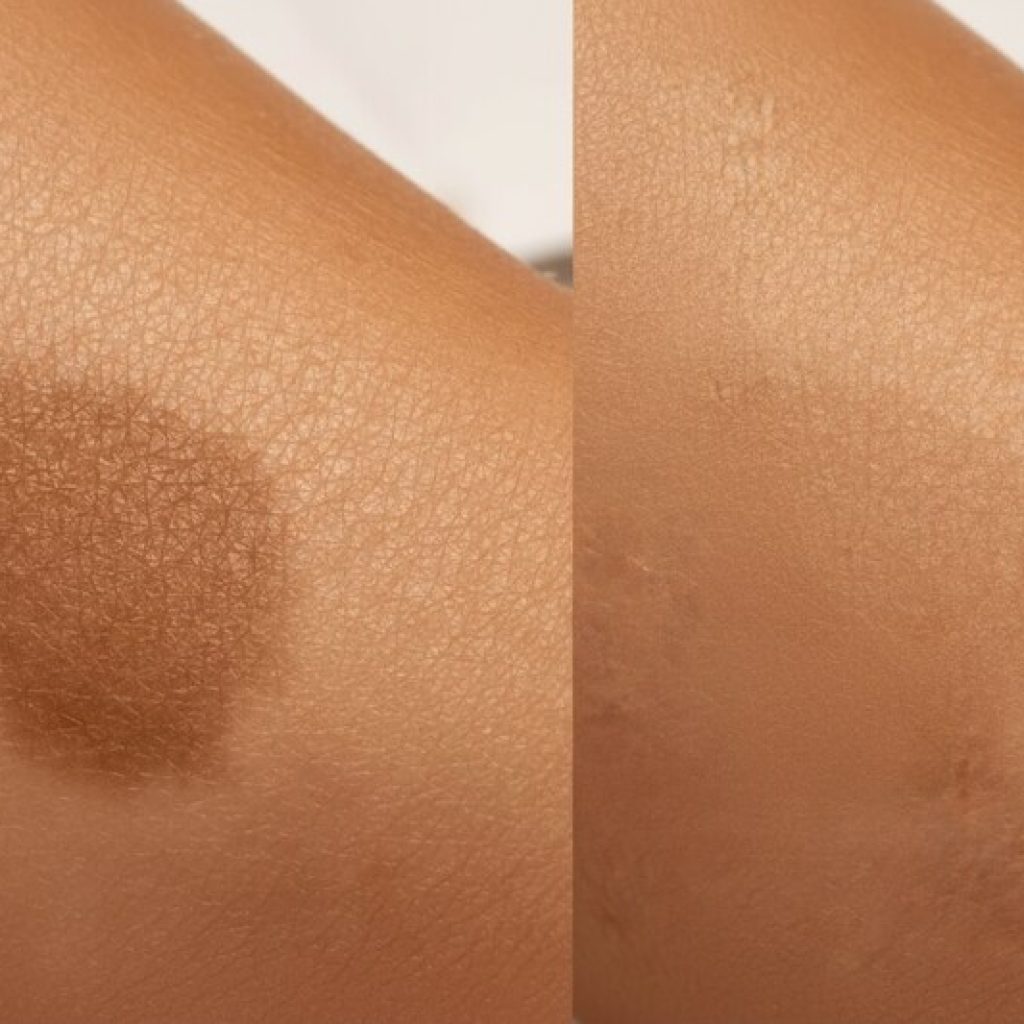 Laser treatment for birthmark removal – before and after comparison