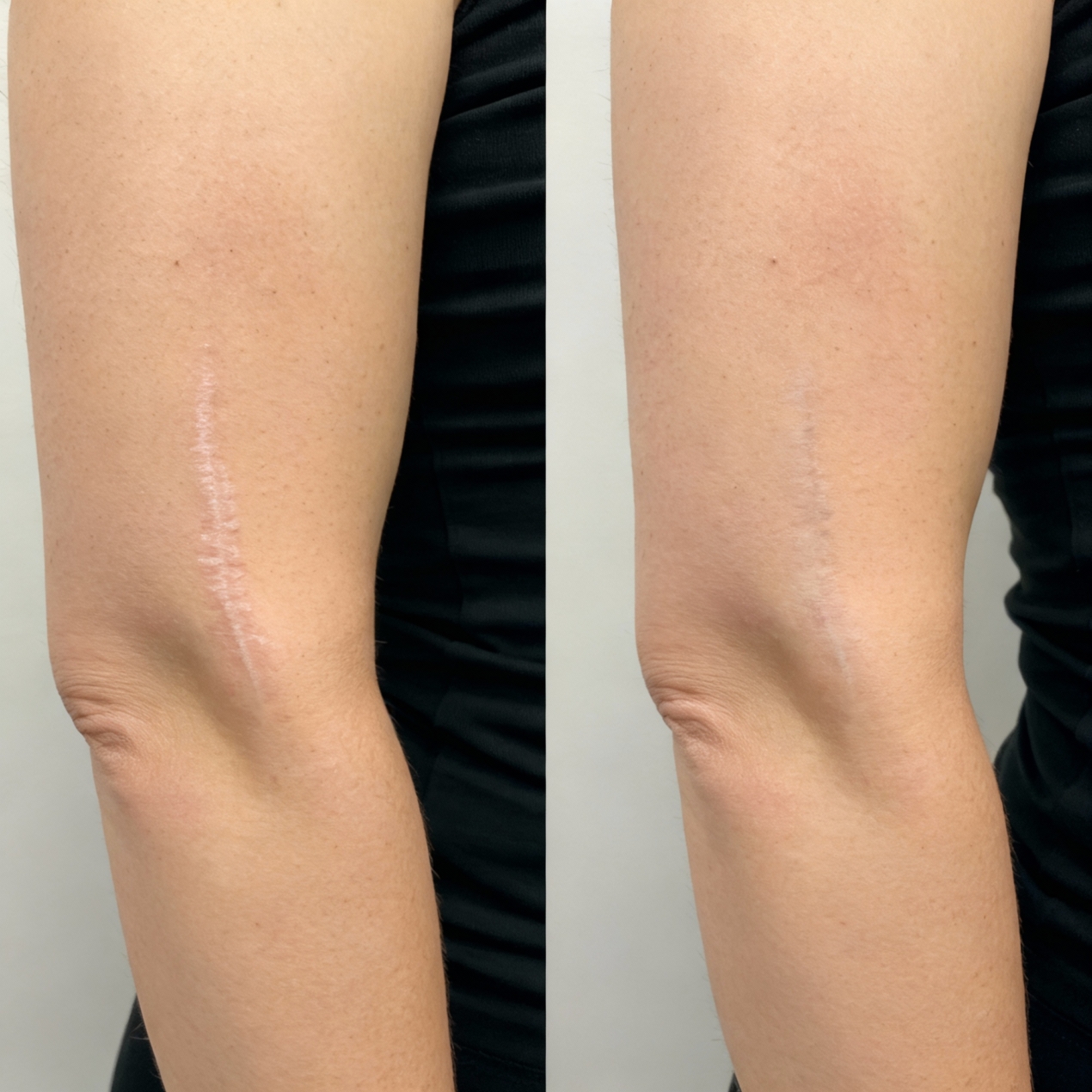 Before and after laser scar revision showing reduced redness and smoother skin