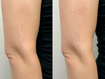 Before and after laser scar revision showing reduced redness and smoother skin