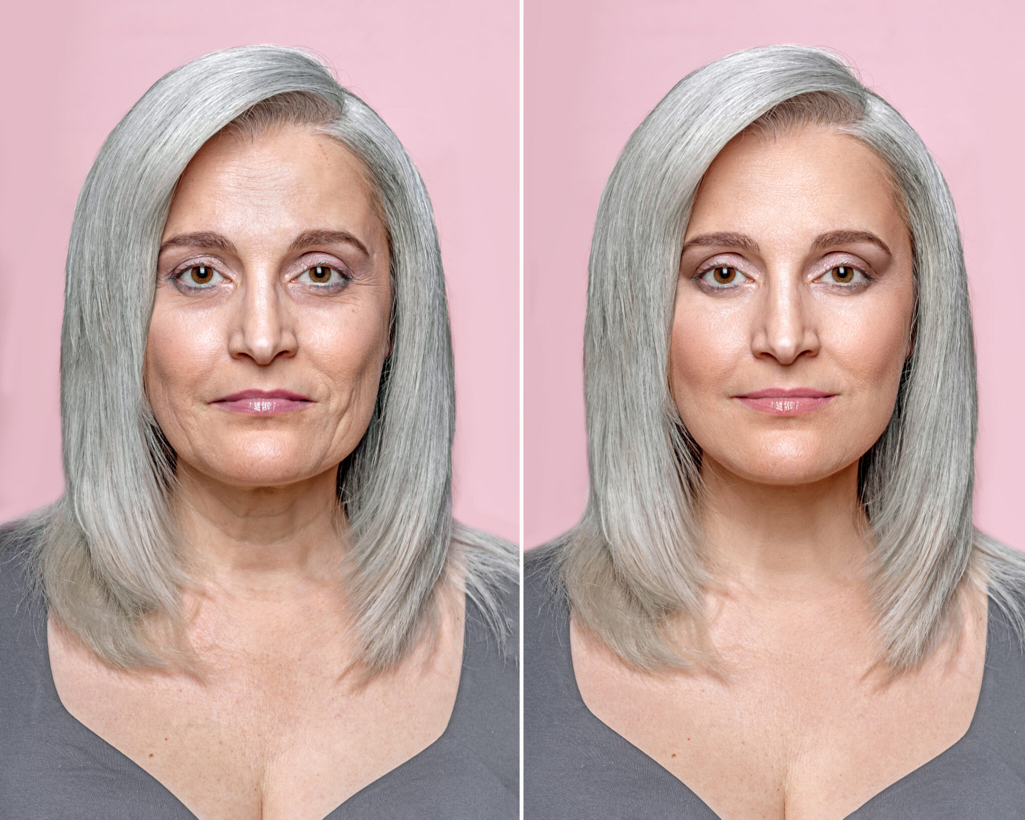Visible skin texture improvement after fractional laser resurfacing