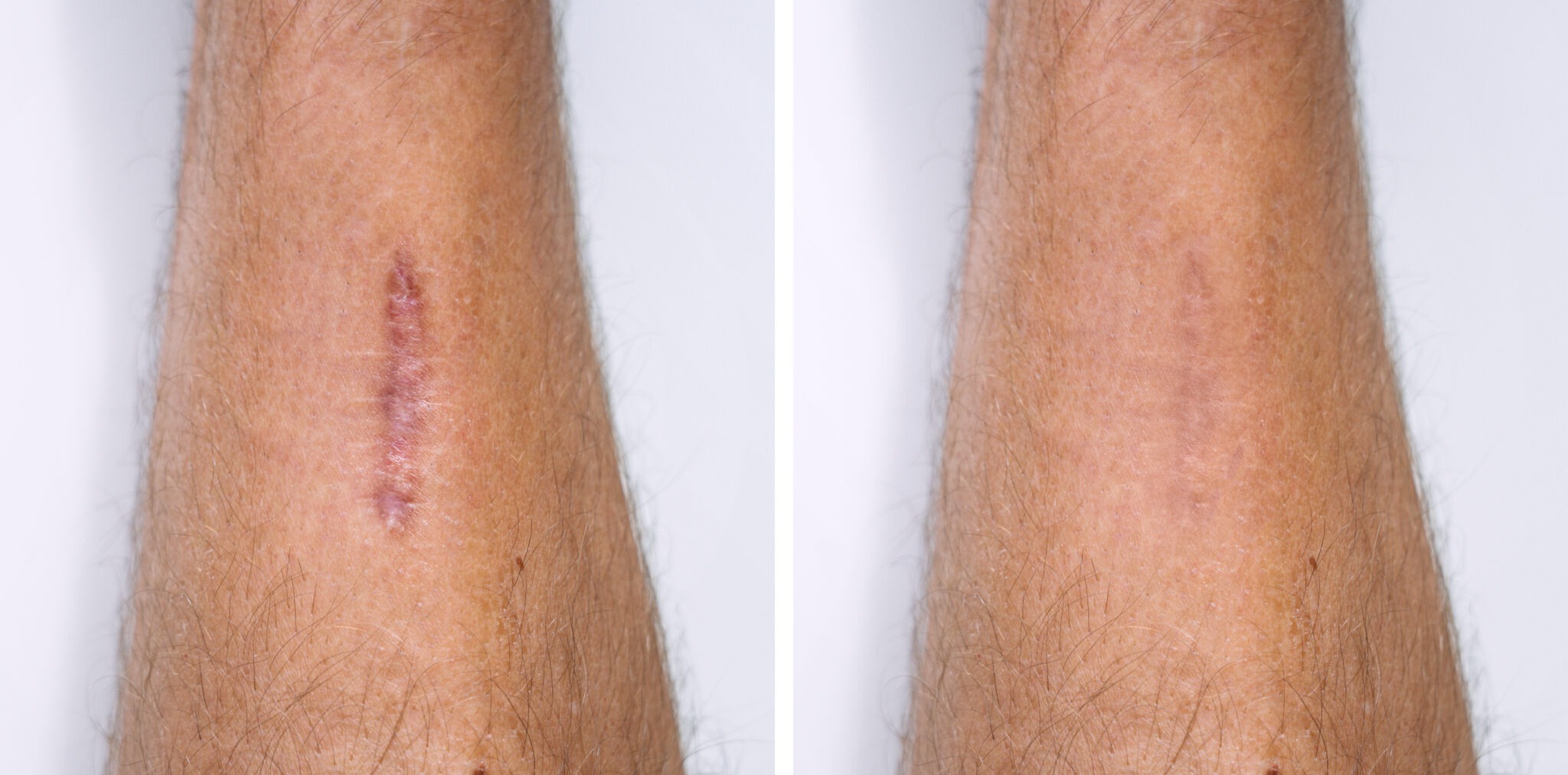 Before and after laser scar removal results