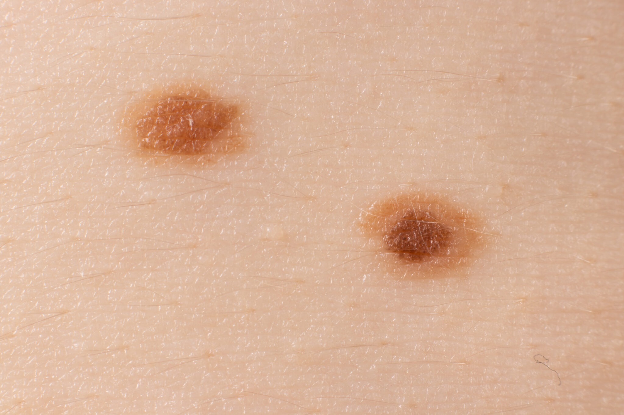 Example of melanoma next to a normal mole