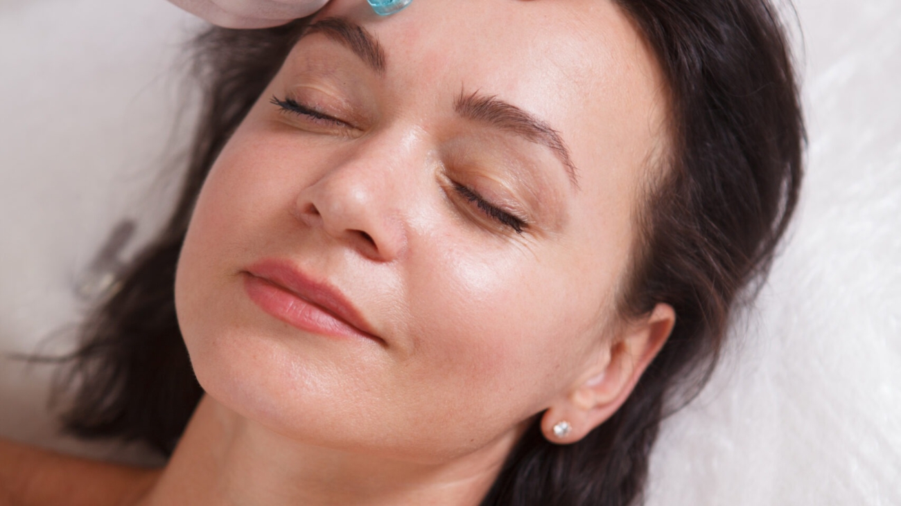 Microneedling treatment for melasma and hyperpigmentation