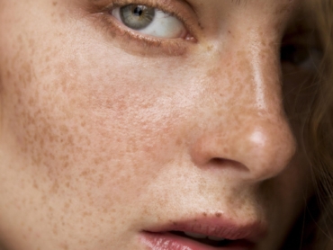 Freckles on Face – Sun-Induced Pigmentation