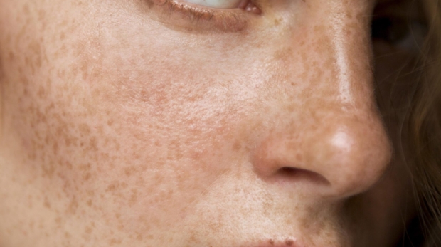 Freckles on Face – Sun-Induced Pigmentation