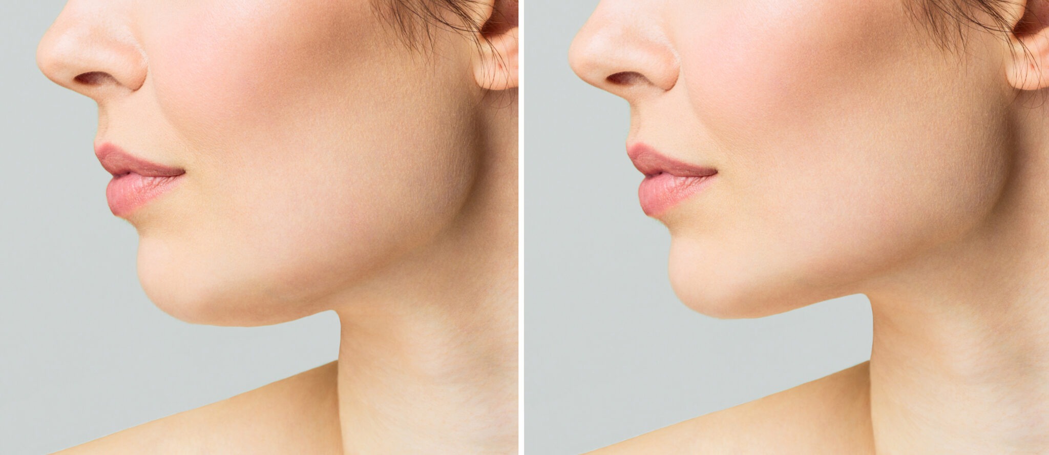 Before and after jawline and chin contouring results at Reveal Clinics Riyadh.