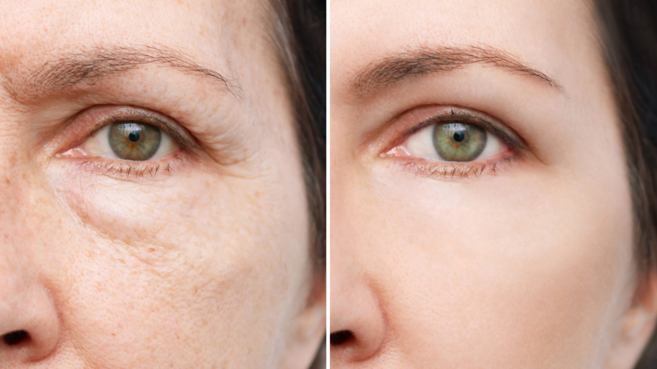 Before and after results of a non-surgical liquid facelift showing natural facial lift and improved contour.