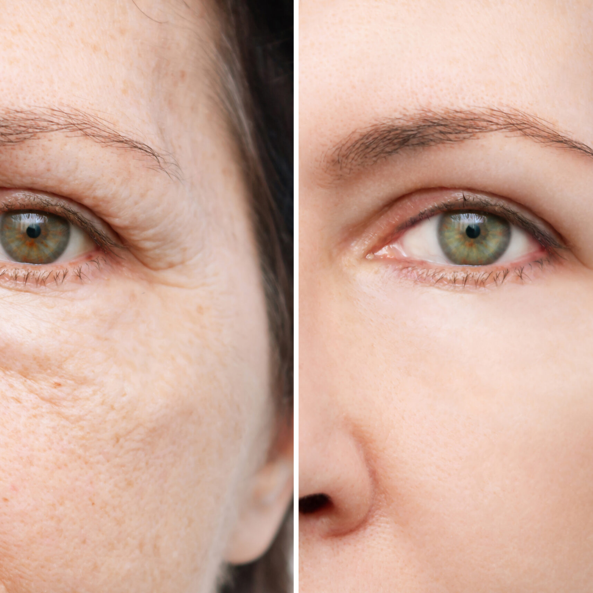 Before and after results of a non-surgical liquid facelift showing natural facial lift and improved contour.