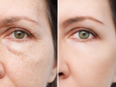 Before and after results of a non-surgical liquid facelift showing natural facial lift and improved contour.