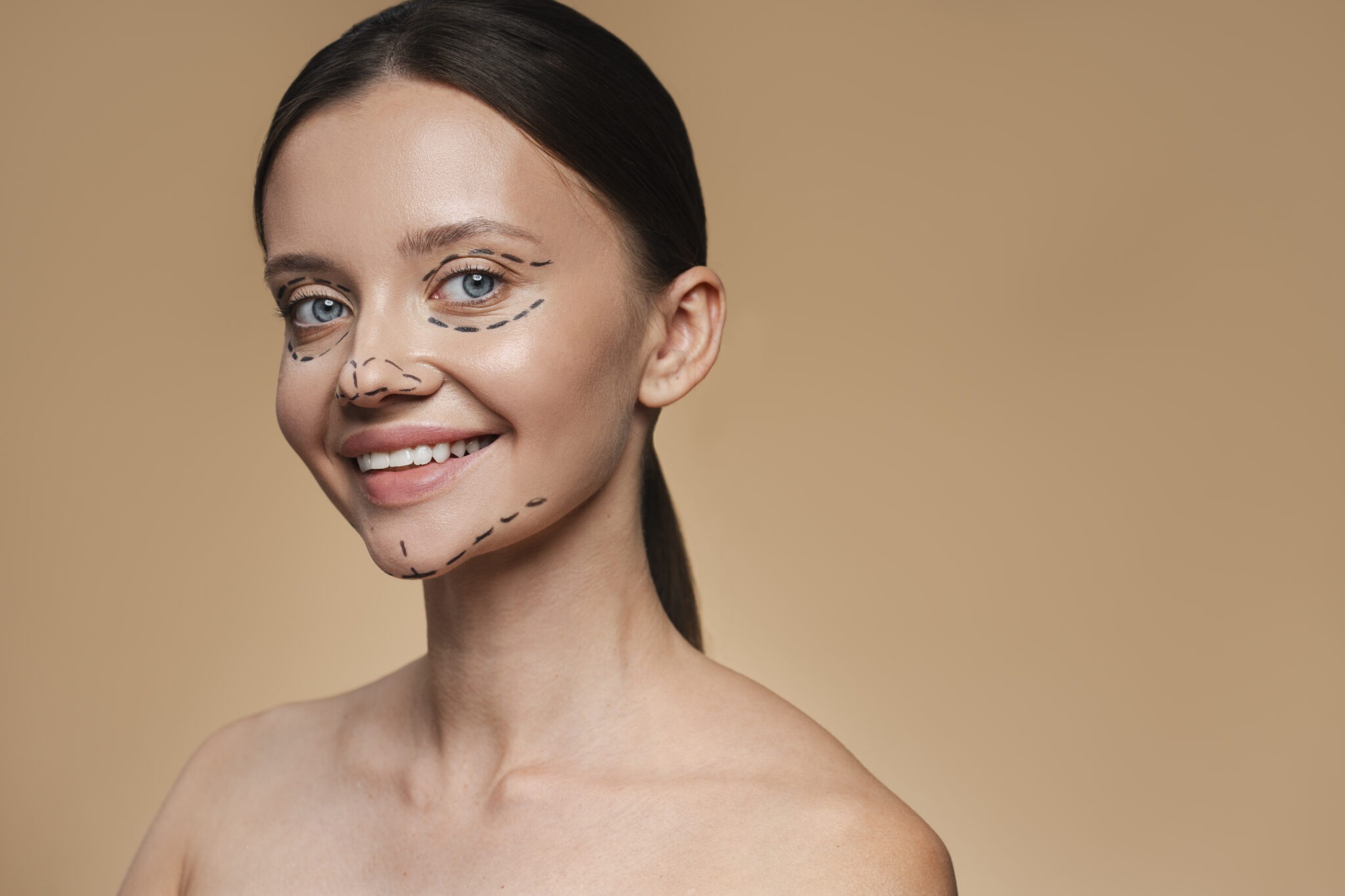 Facial mapping lines drawn on a woman’s face for personalized liquid facelift planning.