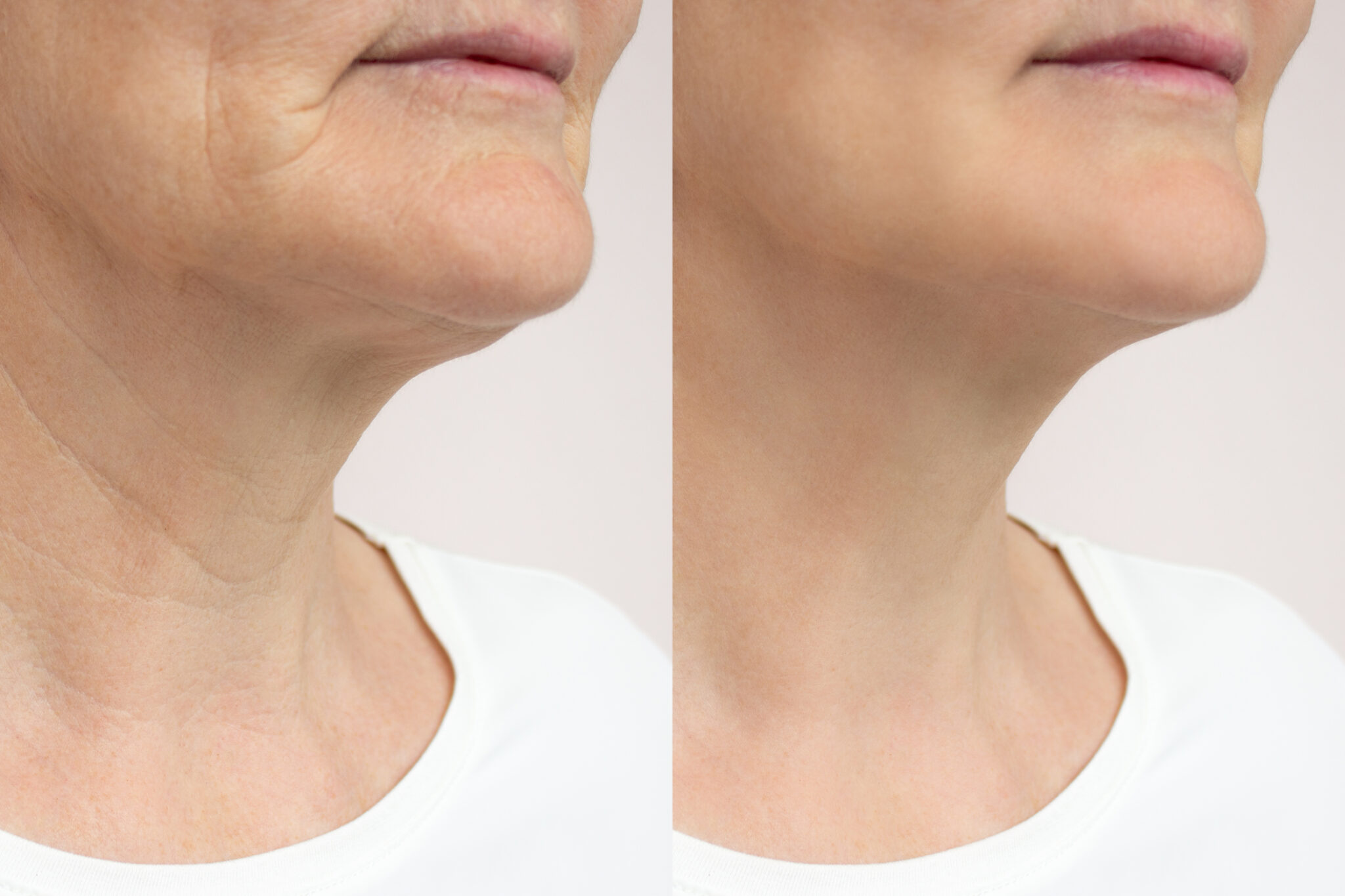Before and after Ultherapy neck tightening results