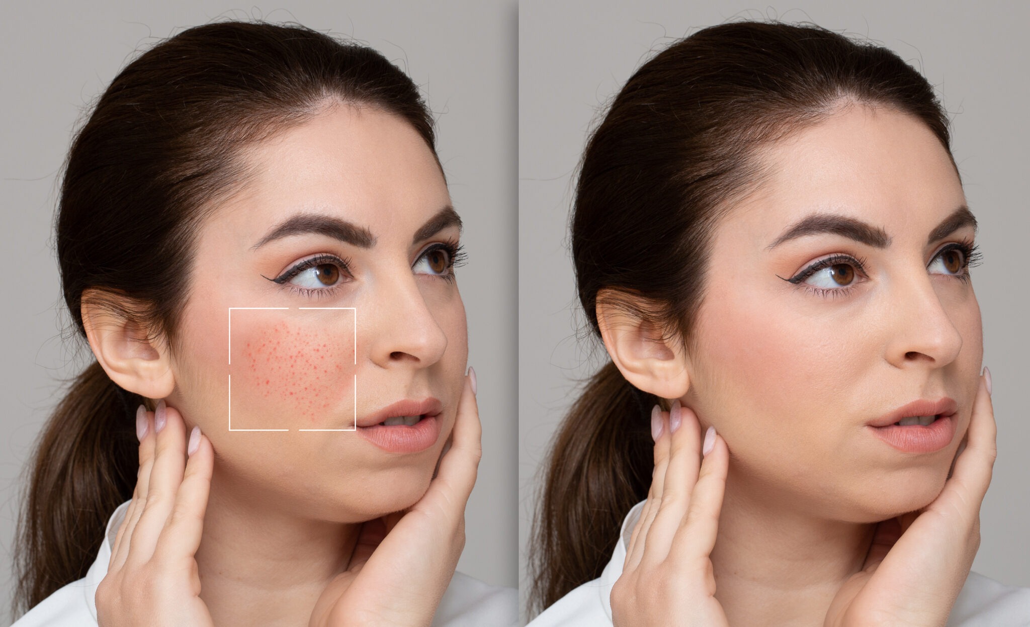 Fraxel Before and After Pigmentation Treatment Riyadh