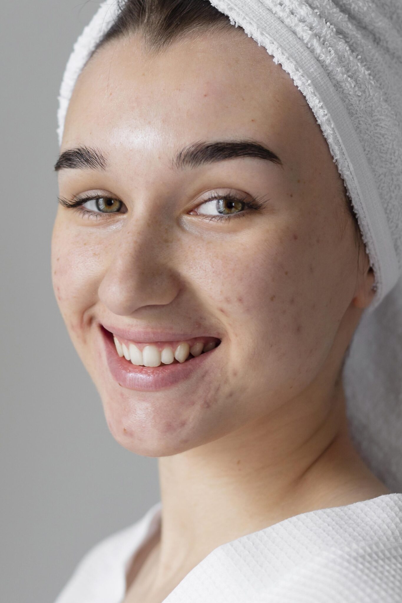 Fractional CO₂ laser treatment for acne scars