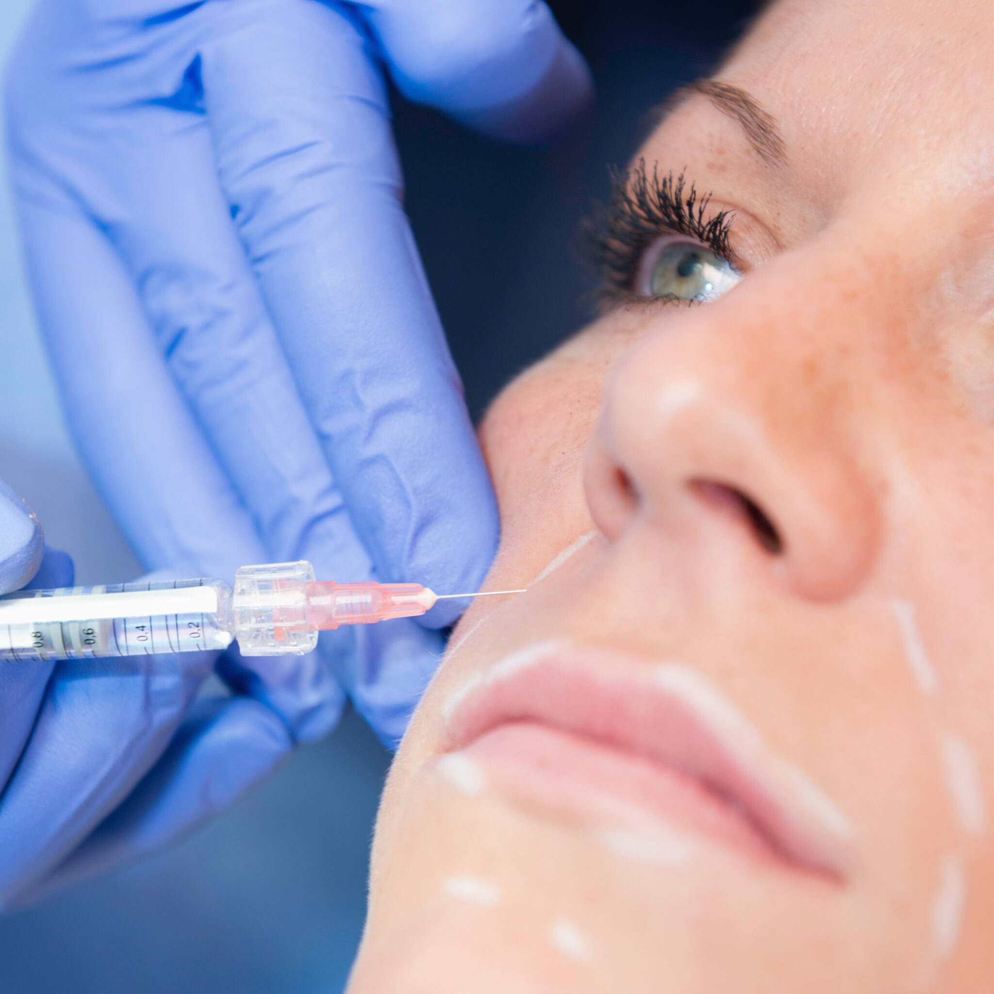 Injectable application during non-surgical lifting procedure
