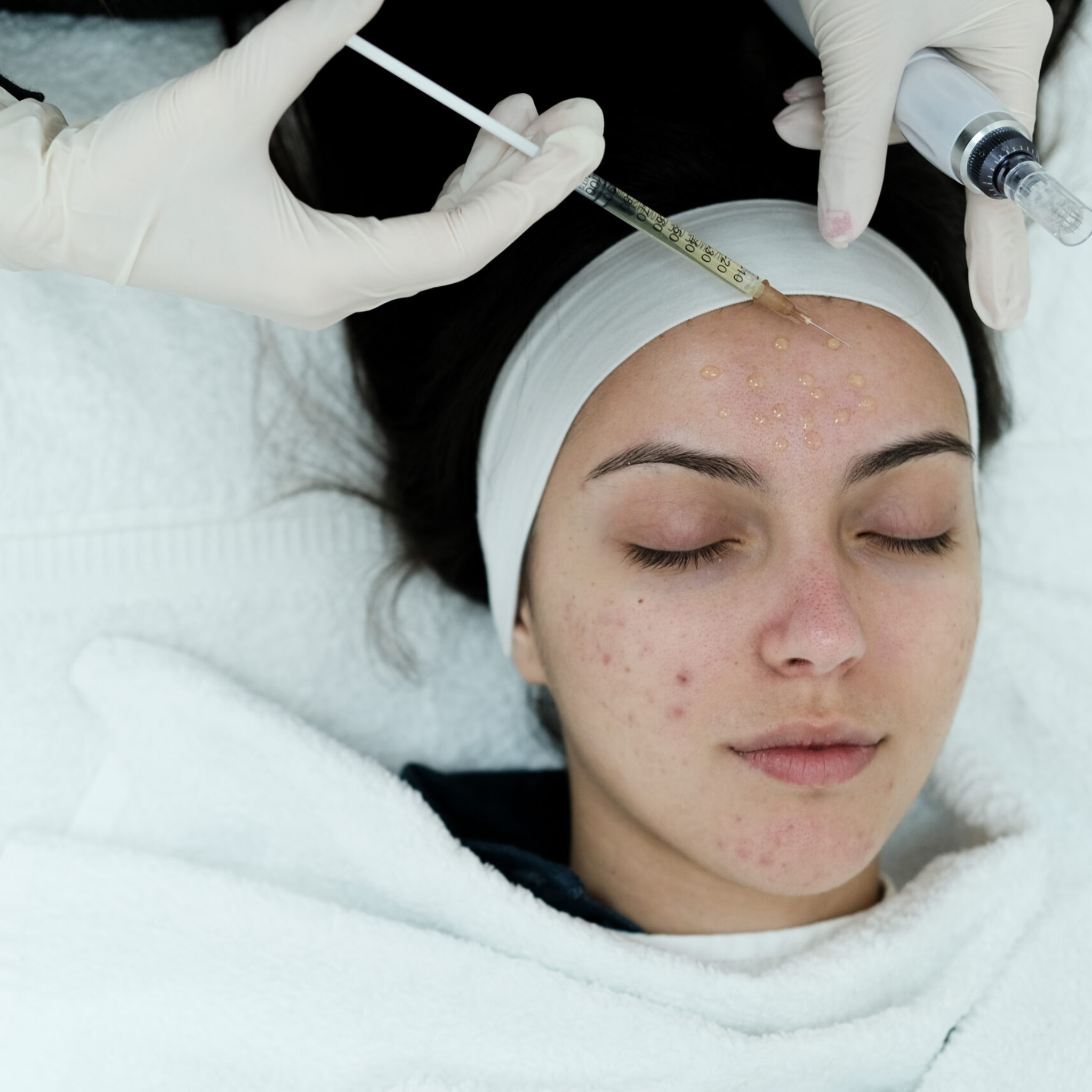 Advanced acne scar treatment at a dermatology clinic in Riyadh