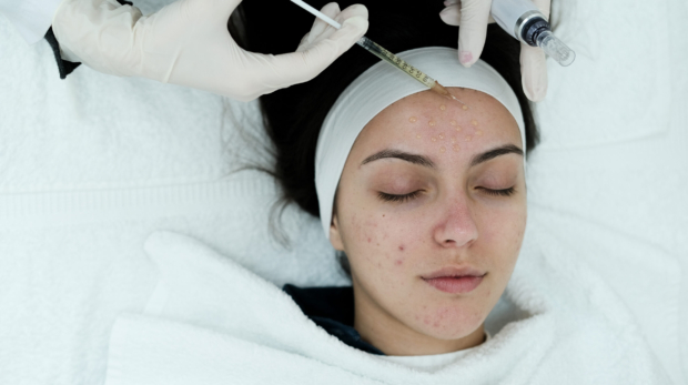 Advanced acne scar treatment at a dermatology clinic in Riyadh