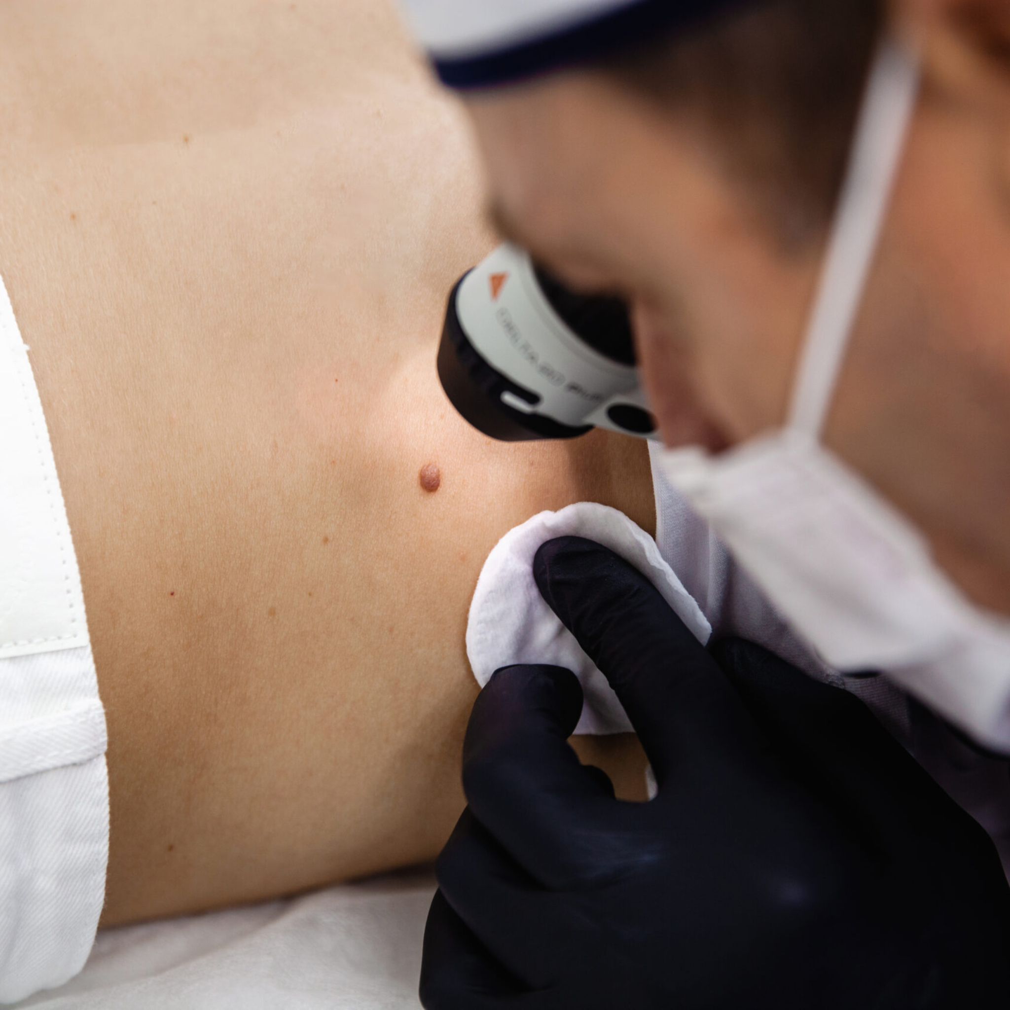 Smart mole management treatment with precision skin evaluation