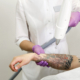 Laser tattoo removal procedure on arm