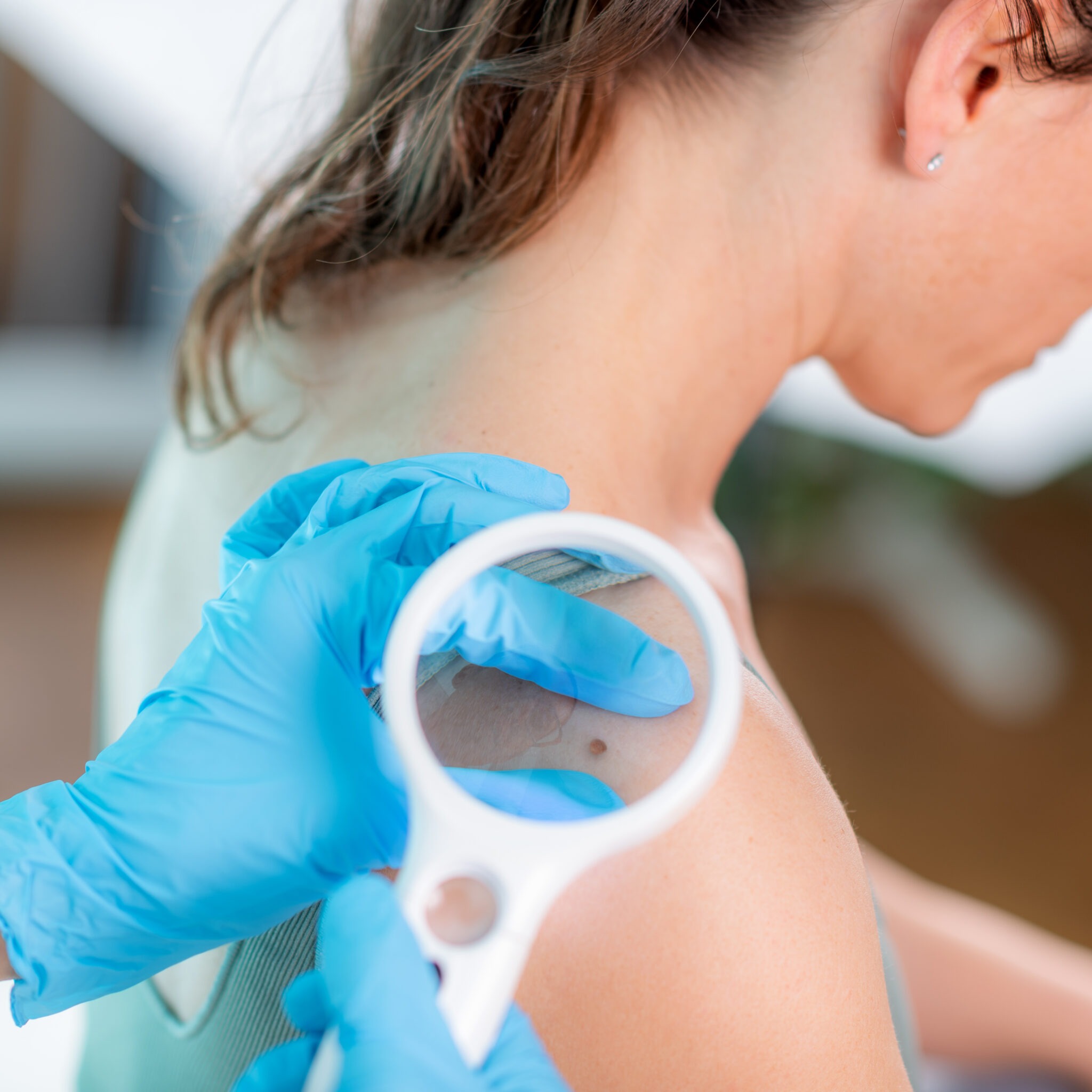 Dermatologist examining birthmark before treatment